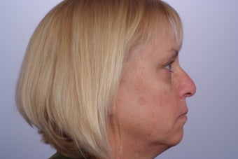 Facelift before 248599