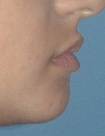 Lip Augmentation before 458991