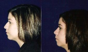 Rhinoplasty and Septoplasty after 241675