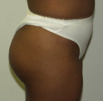 Butt Augmentation after 273286