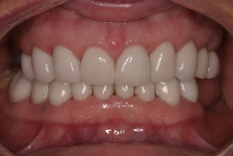 full mouth rehab after 340398