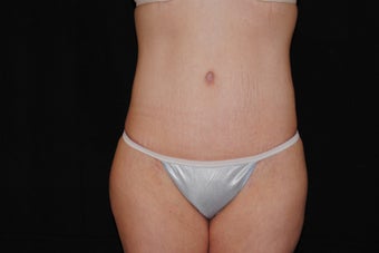 Body Lift after 479774