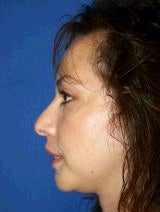 Chin Implants after 357642