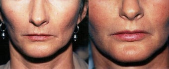 Lip Augmentation before 633527
