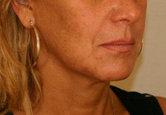 Mini Facelift (Mini lift) before 378851