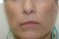 Restylane Treatment for lips before 91062