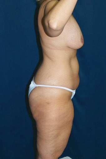 38 Year Old Female, Lower Body Lift (Belt Lipectomy) and Breast Lift with Implants After Weight Loss 629024