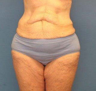 Inner thigh lift before 486116