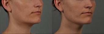 Ultherapy before 541290
