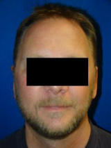 Ear Surgery (otoplasty) after 124914