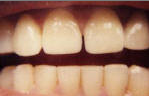 Porcelain Veneers after 535256