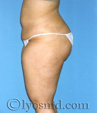 Liposuction after 233708