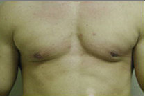 Male Breast Reduction after 141526