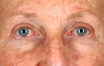 Upper Lid Blepharoplasty after 555133