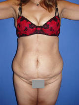 Tummy Tuck Procedure before 131928