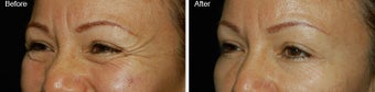 Botox for Crows Feet before 97876