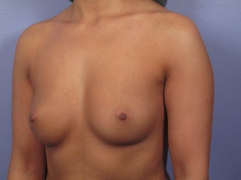 Breast Augmentation before 338702