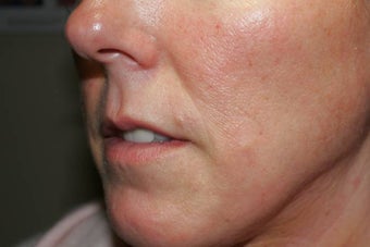 Fillers - Cosmoderm before 136204