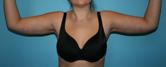 Armlift after 287753