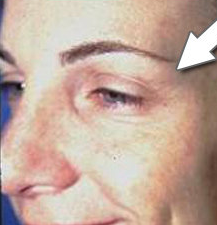 Botox Cosmetic - Crow's Feet after 328095