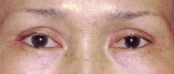 Upper Blepharoplasty after 365451