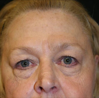 Blepharoplasty before 165947
