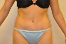 Tummy Tuck after 215069
