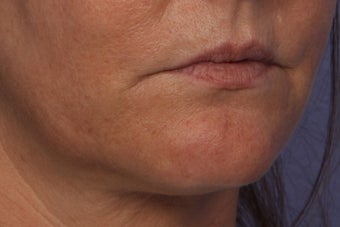 Perlane L to Lips 309740