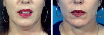 Chin Liposuction before 640742