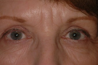 Bilateral Eyelid Lift and Blepharoplasty after 313336