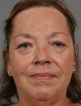 Radiesse & Juvederm after 373933