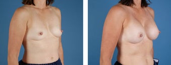 Breast Augmentation after 349398