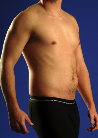 Tummy Liposuction before 229667