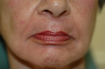 Hetter facial resurfacing after 434879