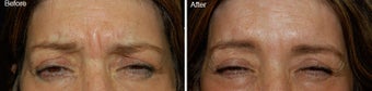 Botox treatment for brow wrinkles before 97863