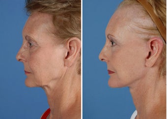 Facelift, browlift, upper and lower eyelids, laser before 253954