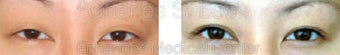 Blepharoplasty before 427702