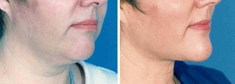 Chin Liposuction before 640708