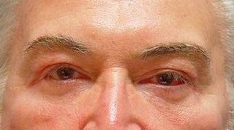 Lower blepharoplasty with fat repositioning after 251709