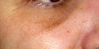 Sculptra before 272059