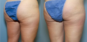 46 year old with cellulite after 644184