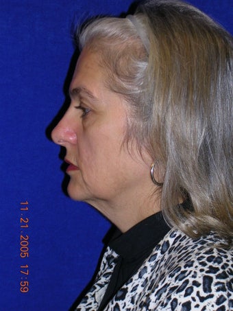 Facelift, Eyelid lift before 466424