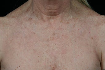 Fraxel Dual Laser after 309241