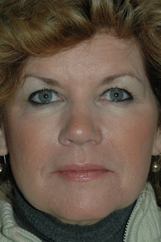 Botox and Fillers after 405385