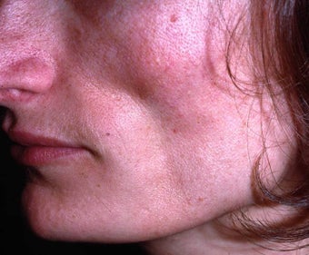 Facial Volumizing before 149211