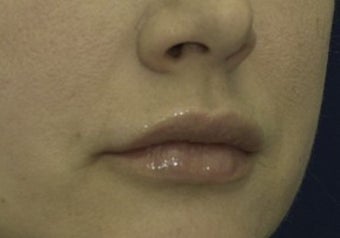Lip Lift before 615879