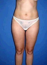 Liposuction Surgery after 157192