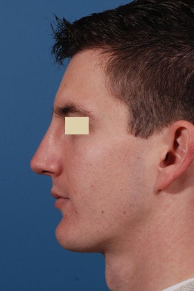Rhinoplasty after 154300