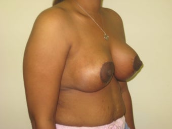 Mastopexy, breast lift 365124