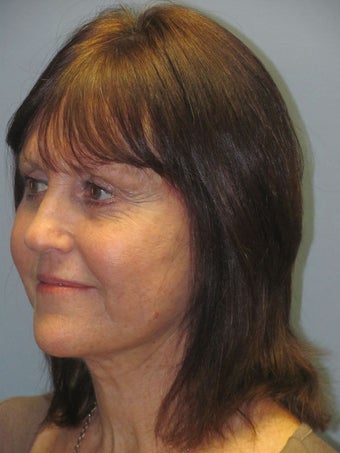 Neck Lift, Platysmaplasty 634720